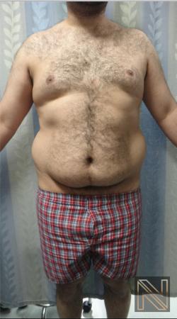 Liposuction Actual Patient Before