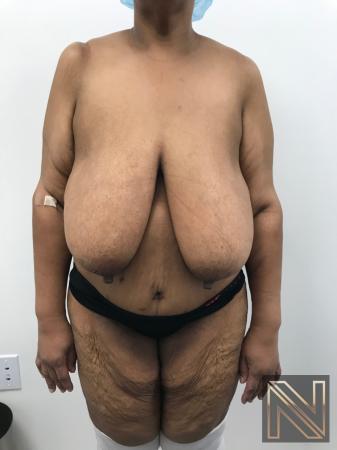 Breast Reduction Actual Patient Before