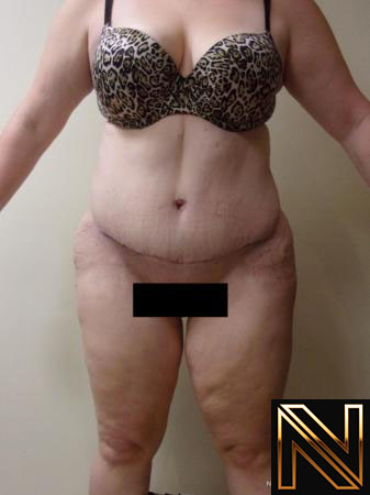 Tummy Tuck Actual Patient After