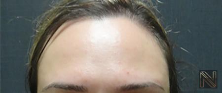 BOTOX® Cosmetic Actual Patient After