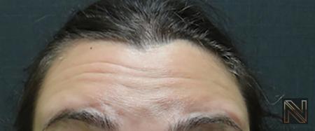 BOTOX® Cosmetic Actual Patient Before