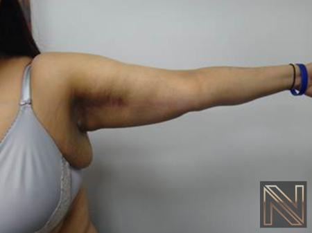 Arm Lift Actual Patient After