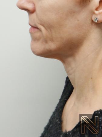 Ultherapy® Actual Patient Before