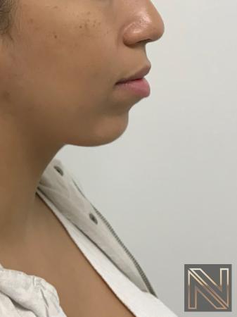 Chin Augmentation Actual Patient After