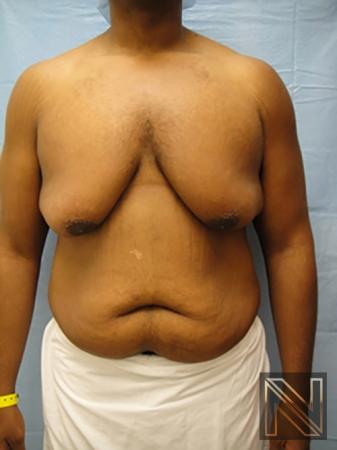 Gynecomastia Actual Patient Before