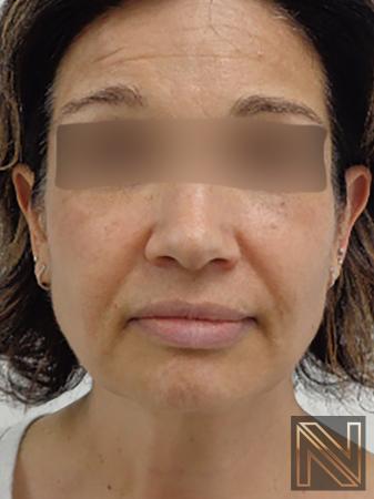 Halo patient results after