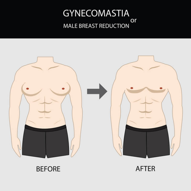 Gynecomastia Results Graphic