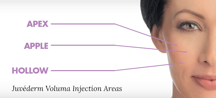 Juvederm Injection location