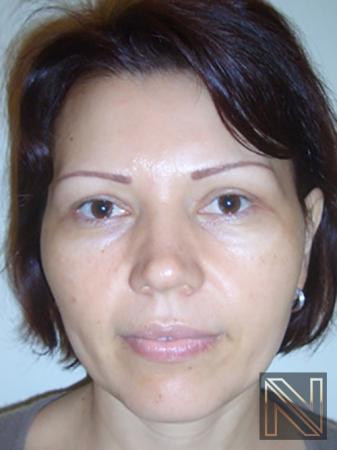 Blepharoplasty Actual Patient After