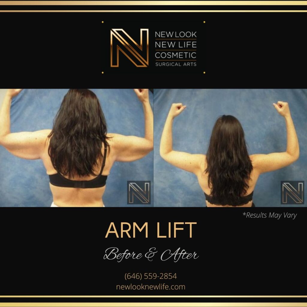 Before and after image showing the results of an arm lift performed in New York.