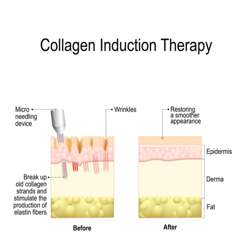 Illustration of what happens to the skin before and after a collagen induction therapy or microneedling treatment.