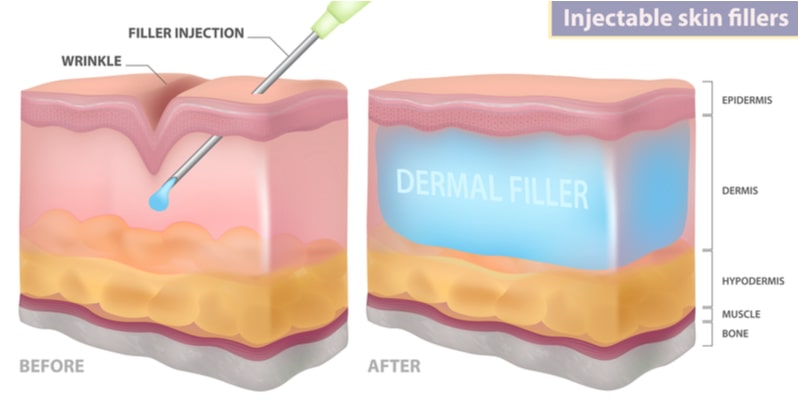 Illustration showing what happens to the skin before and after a dermal filler treatment.