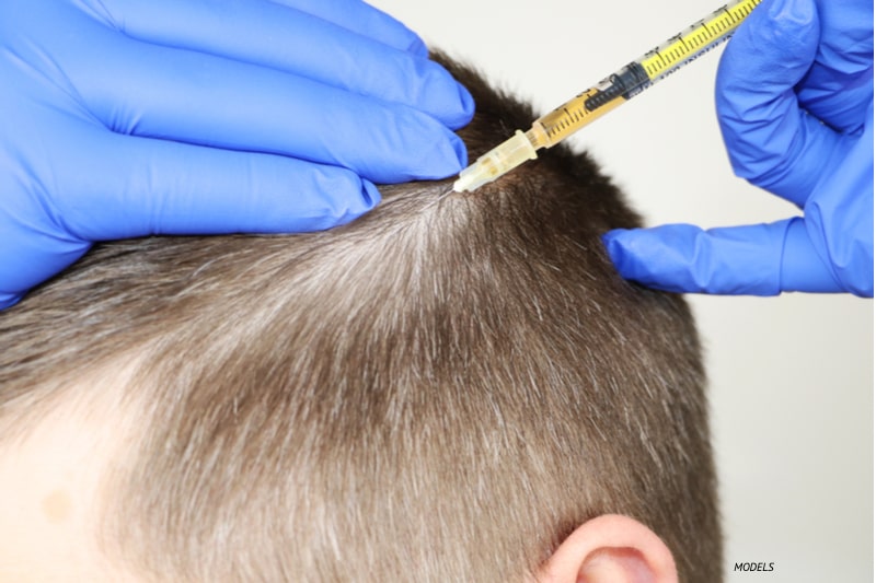 Close up photo of a male patient receiving injection treatment in their scalp