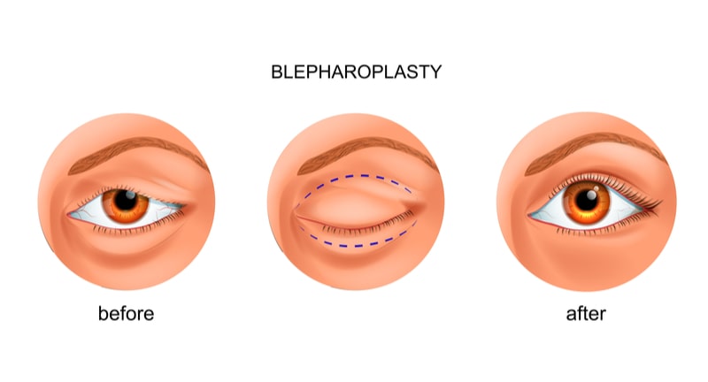 illustration of before and after eyelid surgery.