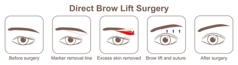 Illustration of brow lift surgery before and after.