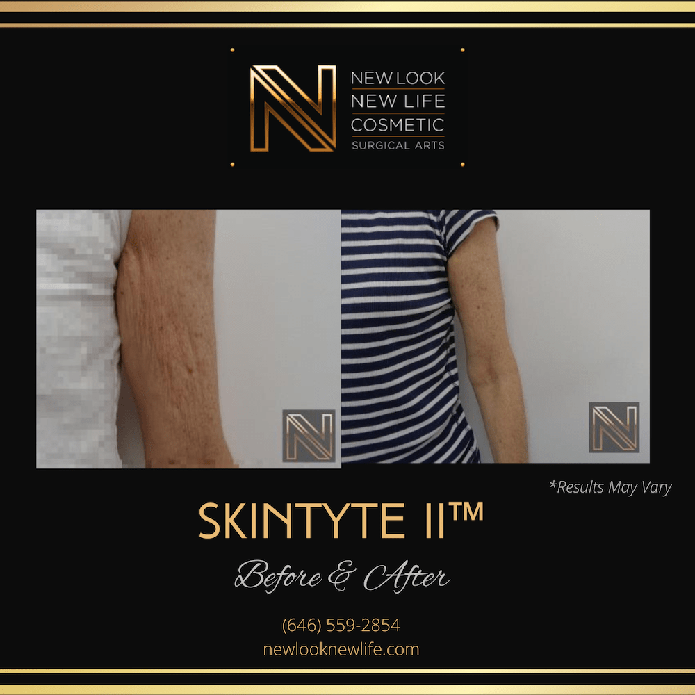 Before and after results showing SkinTyte II™ performed in New York City.