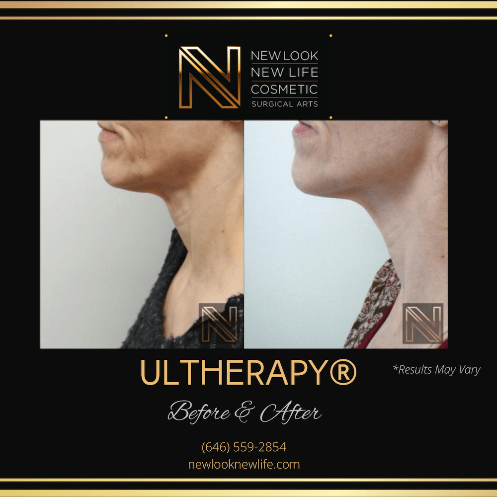 Before and after results showing Ultherapy® performed in New York City.